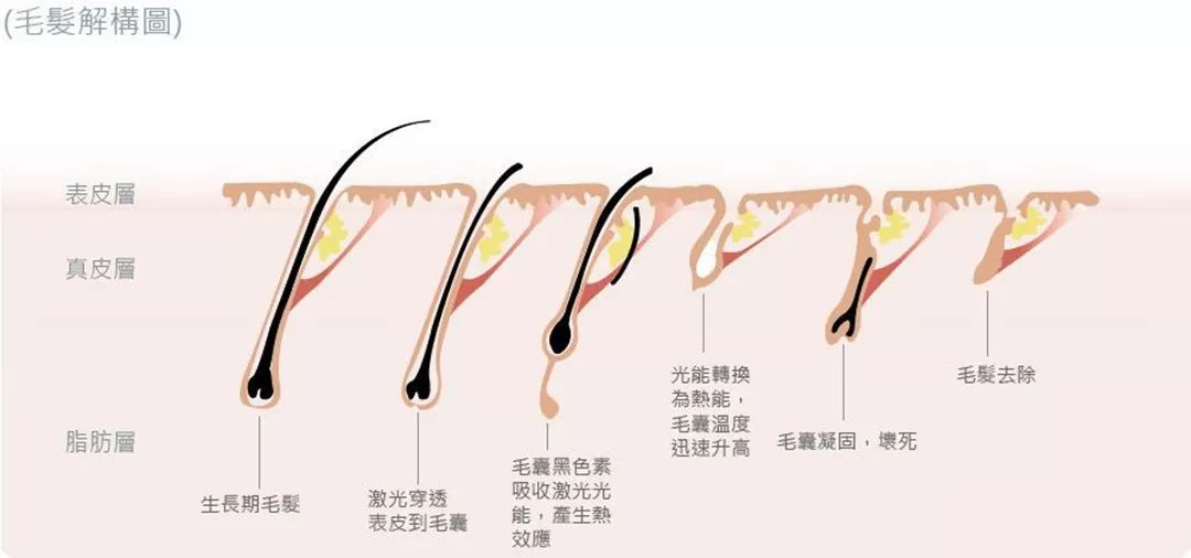 “白煮蛋”與“獼猴桃”之間，還差一個(gè)它 強(qiáng)脈沖脫毛器械，值得買嗎？